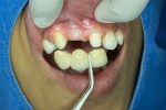 dental bridges in fairview