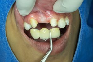 dental bridges in fairview