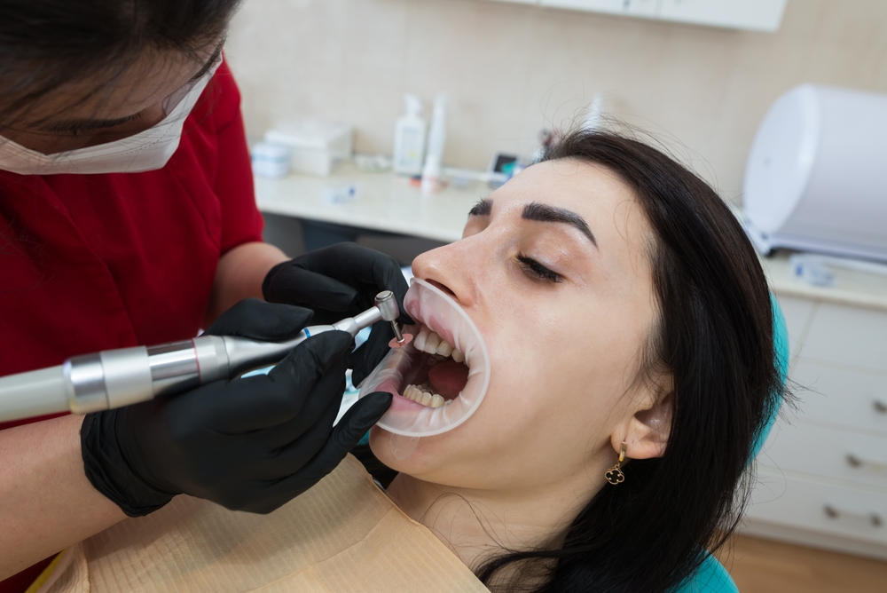The,Dentist,Puts,Dental,Veneers,On,The,Patient.,The,Process