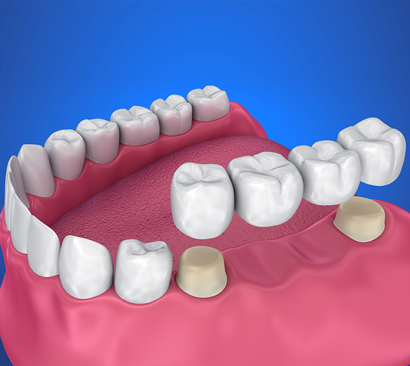 dental bridges in fairview