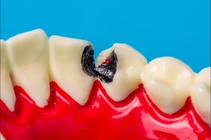 dental fillings in fairview