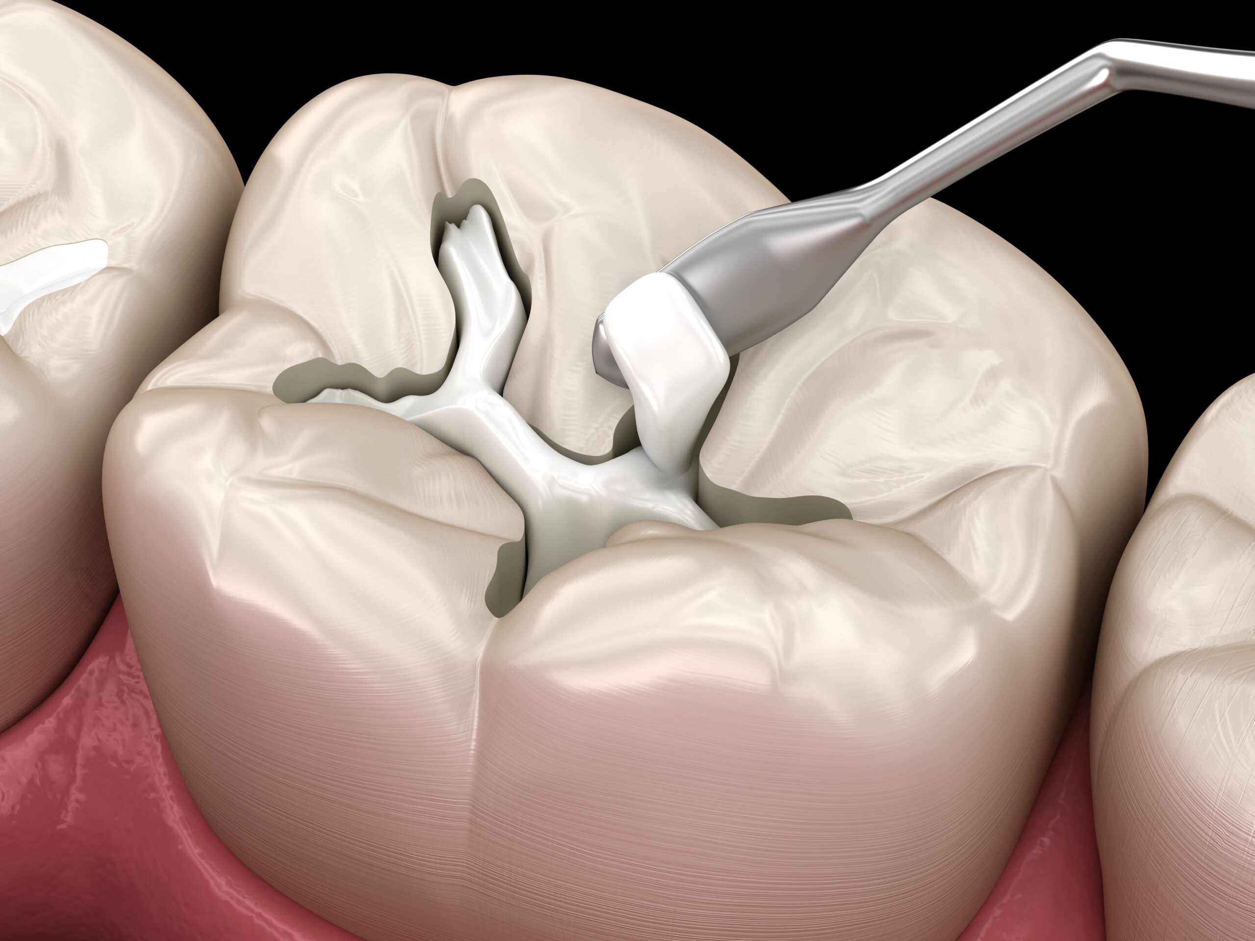 Types of dental fillings